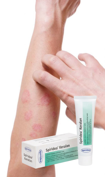 Atopická dermatitida